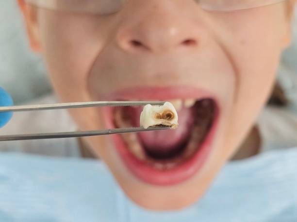 Best Emergency Wisdom Teeth Removal in Haw River, NC